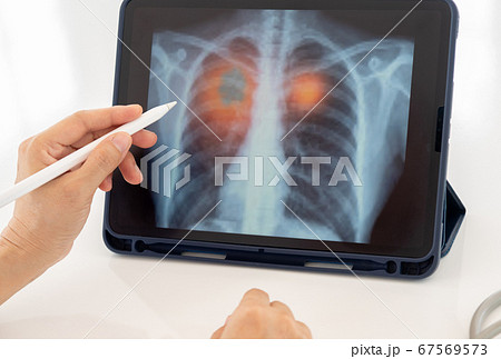 Pneumonia medical x-ray Pneumonia medical x-ray 67569573