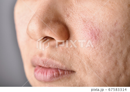 Skin problem with acne diseases, Close up woman face with acne marks and allergy red rash Skin problem with acne diseases, Close up woman face with acne marks and allergy red rash 67583314