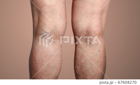 The varicose veins on a legs of woman 67608270