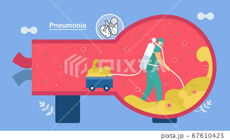 Treatment and clean alveoli. 67610425