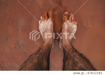 feet men in red blisters from the bites of exotic insects feet men in red blisters from the bites of exotic insects 67622382