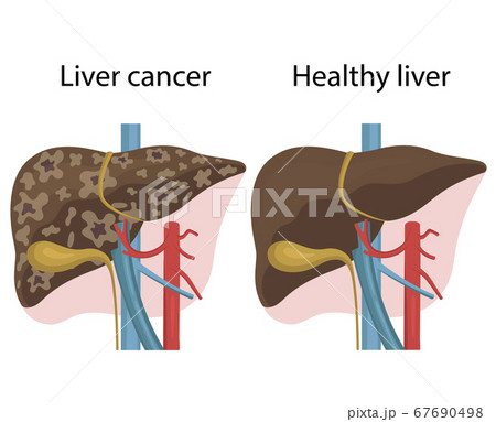 Vector illustration  liver disease Vector illustration  liver disease 67690498