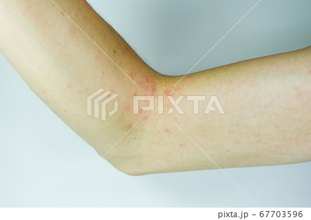 腕に出た湿疹 腕に出た湿疹 67703596