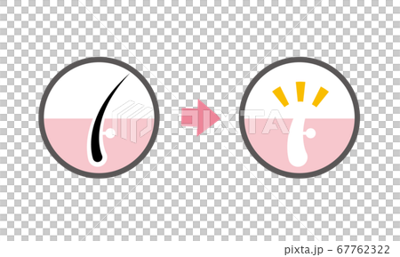 Image illustration of hair loss (hair root, waste hair) 67762322