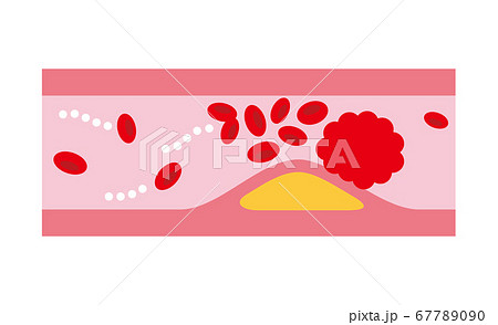 狭くなった血管 67789090