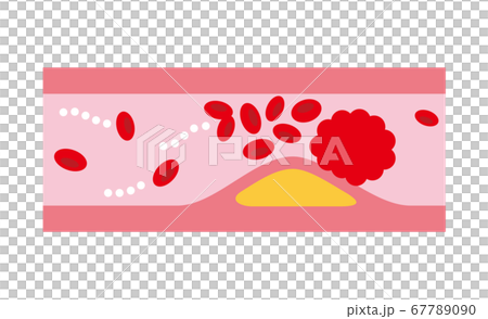 狹窄的血管 67789090