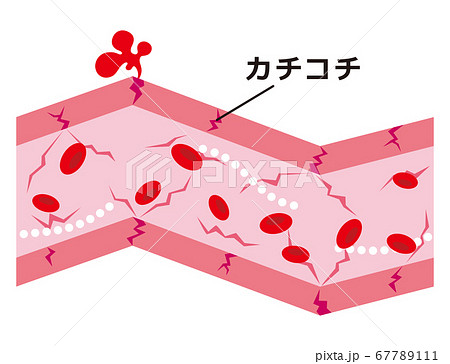 カチコチに硬くなった血管のイラスト素材