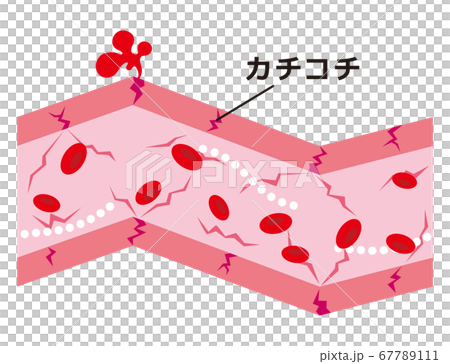 カチコチに硬くなった血管 67789111