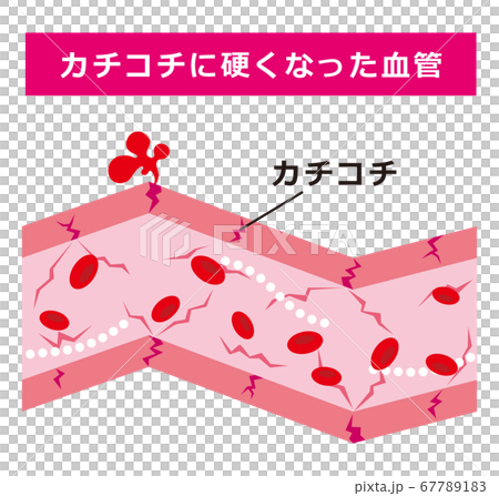 血管硬化 67789183