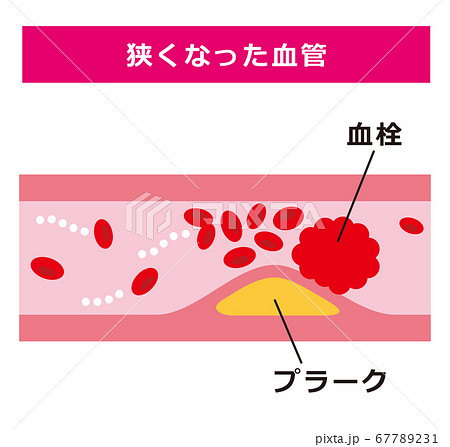 狭くなった血管 67789231
