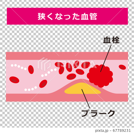 狭くなった血管 67789231