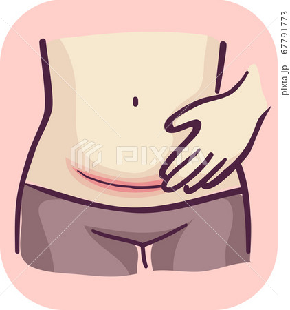 Symptom Redness Cesarean Wound Illustration Symptom Redness Cesarean Wound Illustration 67791773