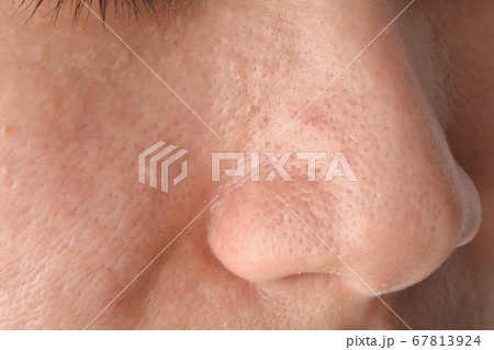 Greasy oily face and comedones, Skin problem with acne scar diseases Greasy oily face and comedones, Skin problem with acne scar diseases 67813924