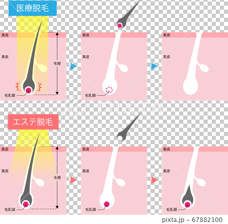 Medical Hair Removal Esthetic Hair Removal Mechanism Cross Section Medical Hair Removal Esthetic Hair Removal Mechanism Cross Section 67882100