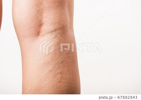 Woman painful varicose and spider veins on leg 67882843