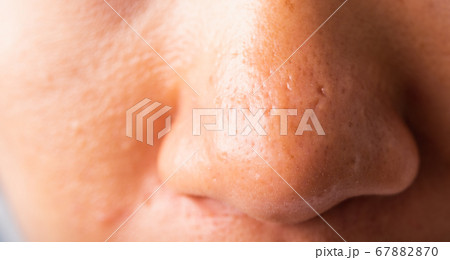Woman large pores have freckles cheek oily, acne 67882870