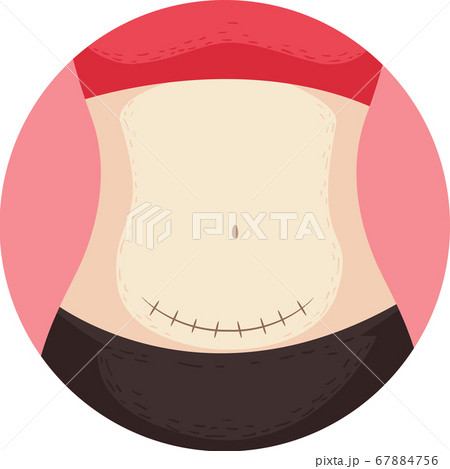 Cesarean Section Surgery Stitches Illustration Cesarean Section Surgery Stitches Illustration 67884756