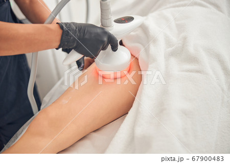 Woman getting relifting treatment on her legs 67900483