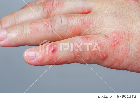 Shingles, Zoster or Herpes Zoster symptoms on arm 67901382