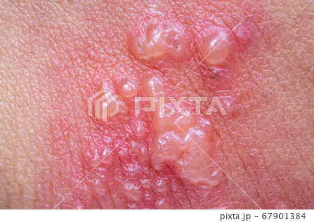 Shingles, Zoster or Herpes Zoster symptoms on arm Shingles, Zoster or Herpes Zoster symptoms on arm 67901384