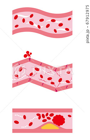 健康な血管 動脈硬化の血管のイラスト素材