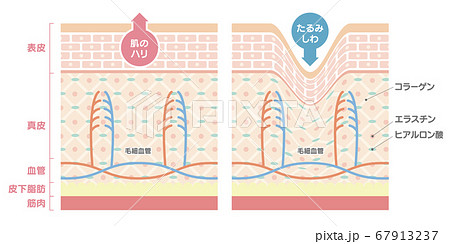 正常な肌としわのある肌を比較した肌の断面図、イラスト 正常な肌としわのある肌を比較した肌の断面図、イラスト 67913237