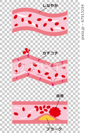 健康な血管 動脈硬化の血管のイラスト素材