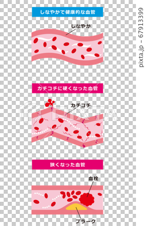 健康な血管 動脈硬化の血管のイラスト素材