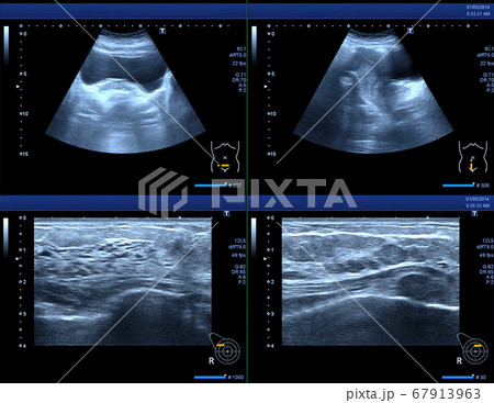 ultrasound uterus image 67913963