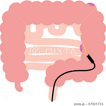 大腸ポリープのイラスト　内臓　消化器　検査 67925733
