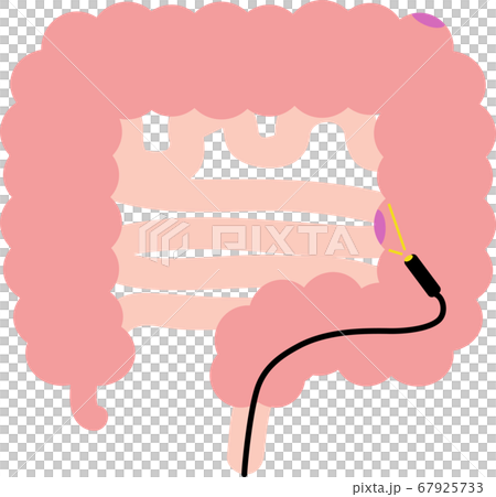 Illustration of large intestine polyp Internal organ digestive examination 67925733