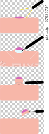 Illustration of polypectomy - Stock Illustration [67925734] - PIXTA