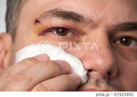 close view of a bruise near the eye, the face of a 67925802