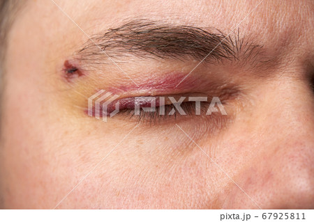 close view of a bruise near the eye, the face of a close view of a bruise near the eye, the face of a 67925811