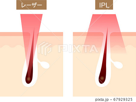 レーザー脱毛　IPL脱毛　断面図 67929325