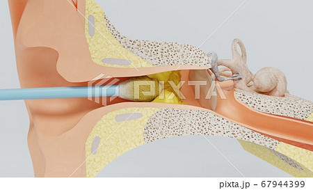 3d render ear cleansing earwax ear stick. 3d illustration 67944399