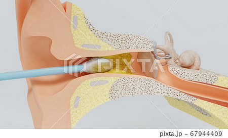 3d render ear cleansing earwax ear stick. 3d illustration 3d render ear cleansing earwax ear stick. 3d illustration 67944409