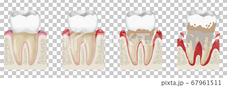 牙齦炎和牙周炎的插圖 67961511