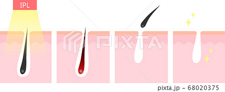 IPL脱毛 断面図 IPL脱毛 断面図 68020375