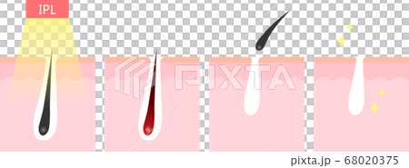 IPL脱毛 断面図 IPL脱毛 断面図 68020375