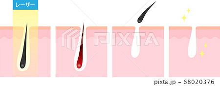 レーザー脱毛 断面図 レーザー脱毛 断面図 68020376