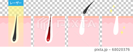 レーザー脱毛 断面図 レーザー脱毛 断面図 68020376