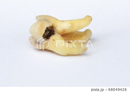 Rotten molar with a big hole in it Rotten molar with a big hole in it 68049426