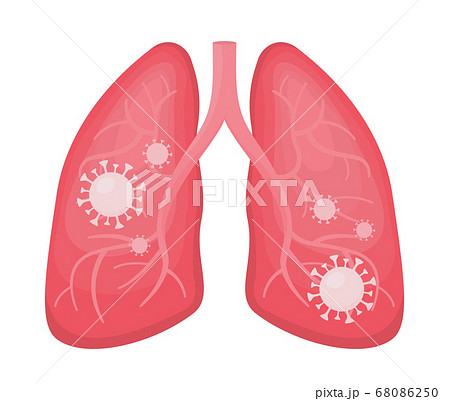 Human lungs infected viral pneumonia and covid 19 68086250