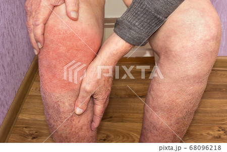 Senior man holding the knee with pain. Collage. Senior man holding the knee with pain. Collage. 68096218
