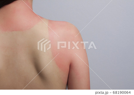 sunburn. red skin is around the shirt, effect from sunburn. sunburn. red skin is around the shirt, effect from sunburn. 68190064