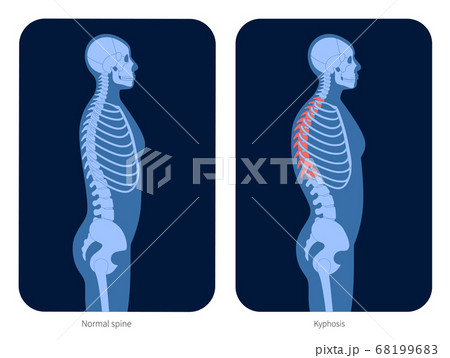 Spine X ray Spine X ray 68199683