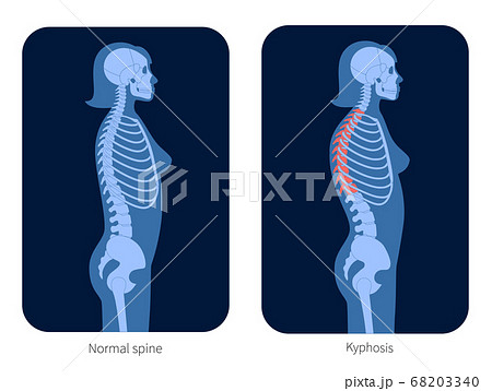 Spine X ray 68203340