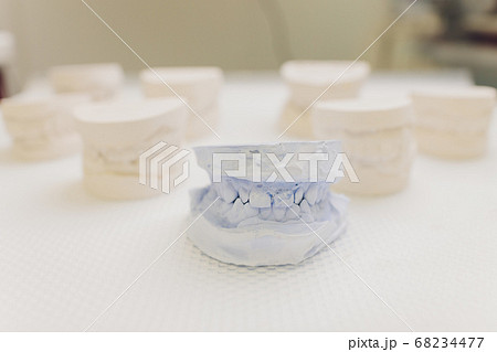 Dental casting gypsum model of human jaws. Crooked teeth and distal bite. Shots were made before treatment with braces . Technical shots on gray background. 68234477