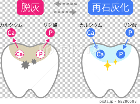 歯 脱灰と再石灰化のイラスト素材